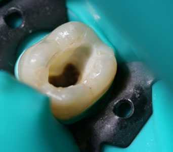 Съвременен, безболезнен <br/> подход в лечението <br/> на зъбите